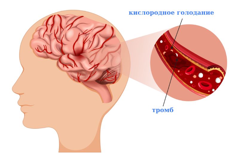 Ишемический инсульт головного мозга у пожилых