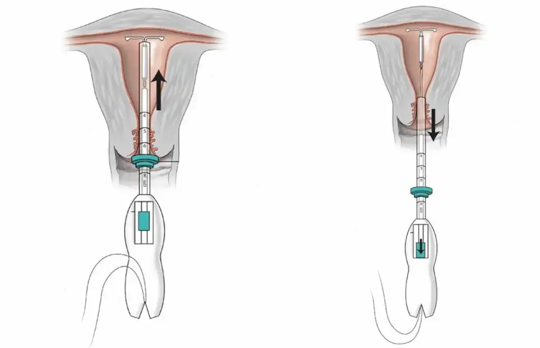 Как происходить установка и удаление внутриматочной спирали в матку
