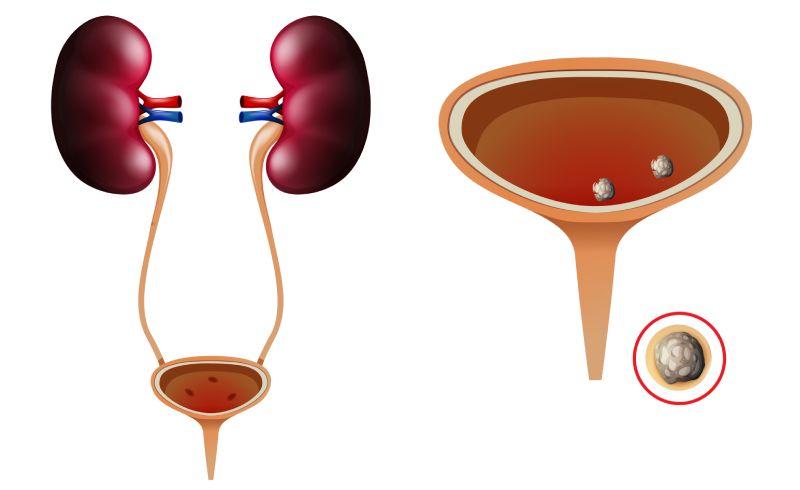 Камни в мочевом пузыре