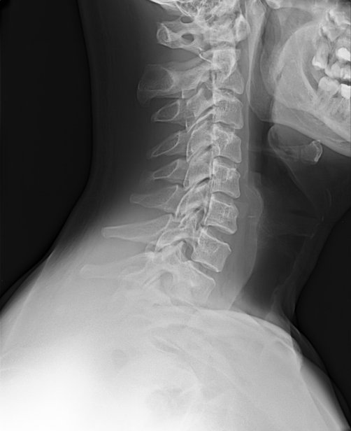 Аномалия Киммерли в шейном отделе