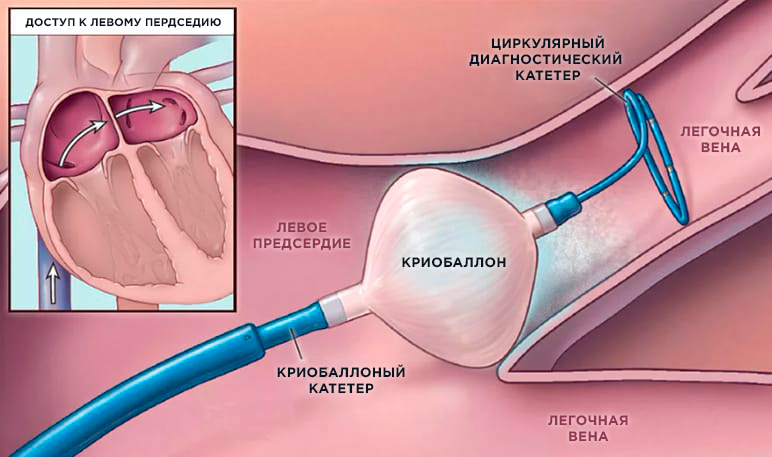 Криоабляция