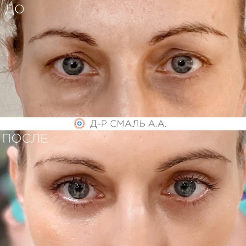 Блефоропластика верхних и нижних век - до и после Блефоропластика верхних и нижних век - до и после