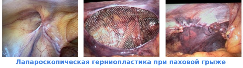 Лапароскопическая герниопластика
