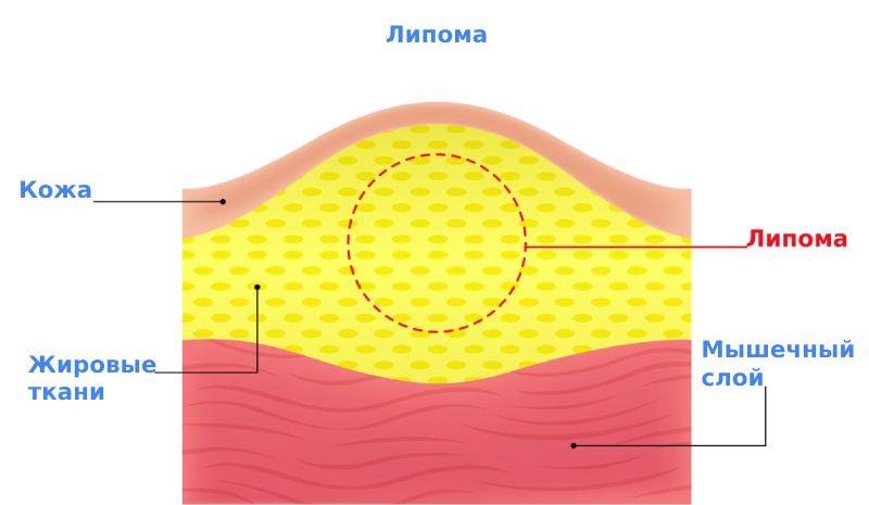 Симптомы липомы Симптомы липомы