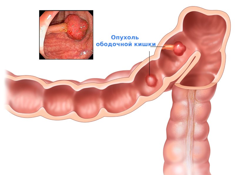 Опухоль ободочной кишки
