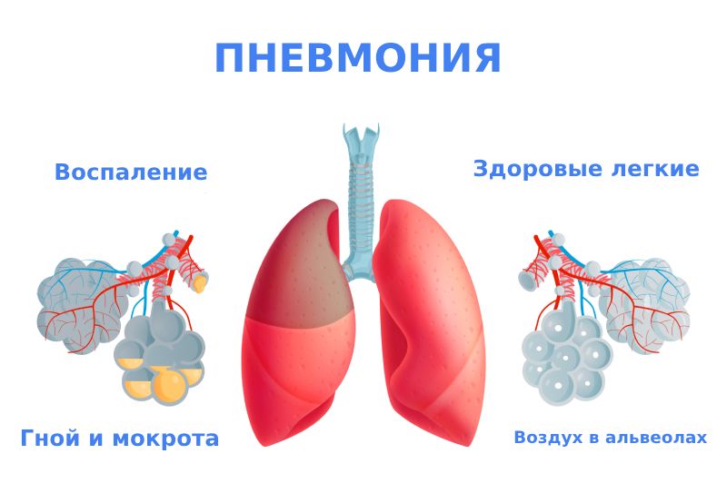 Воспаление лёгких