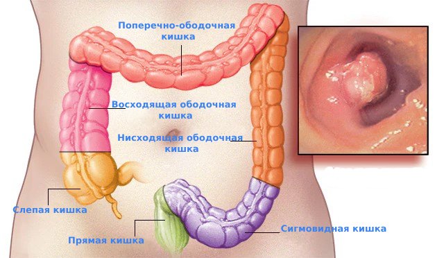 Образование ободочной кишки