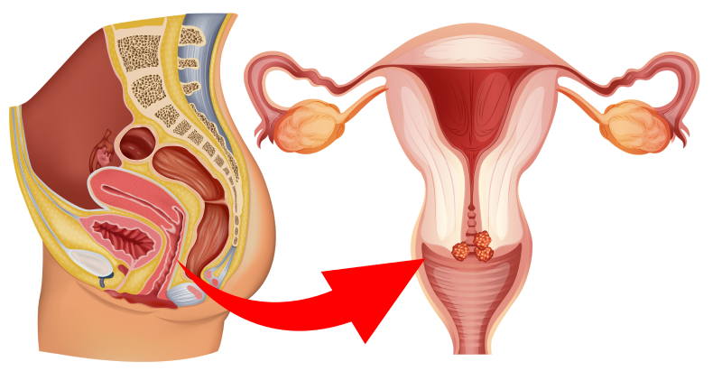 результаты кольпоскопии