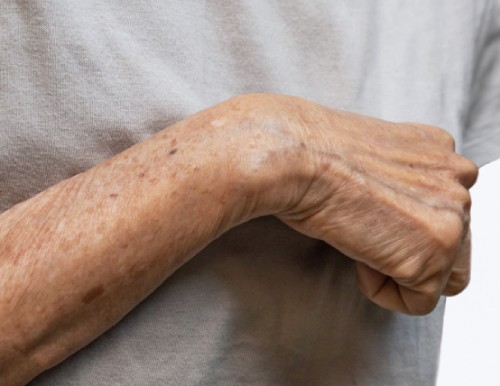 Реабилитация после спастичности