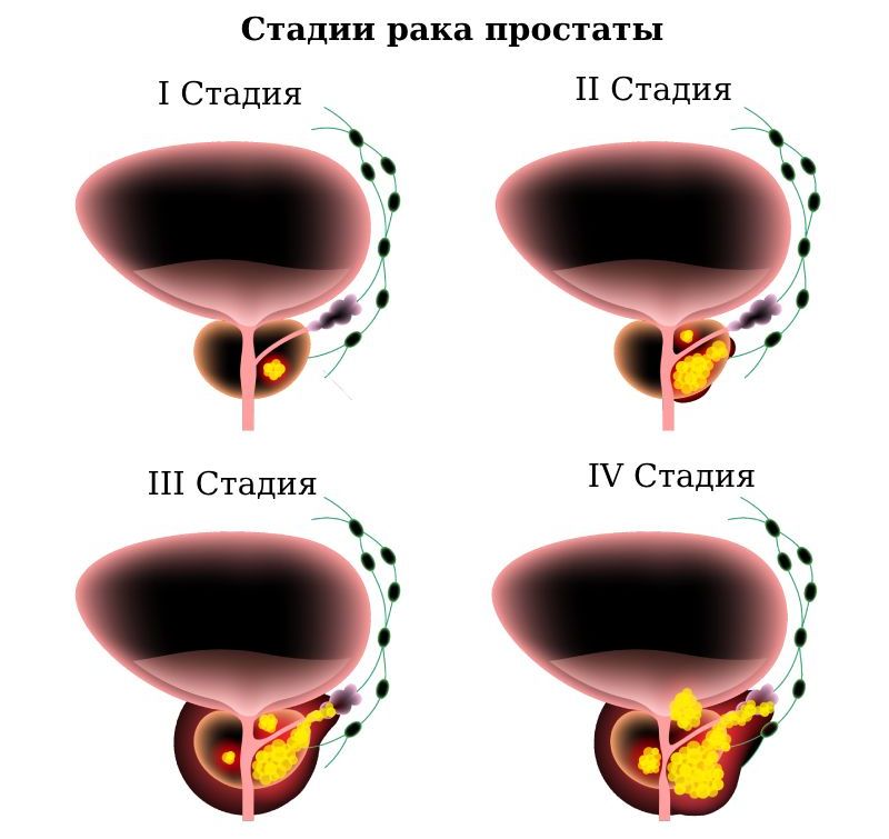 Рак предстательной железы 1, 2, 3, 4 степени Рак предстательной железы 1, 2, 3, 4 степени