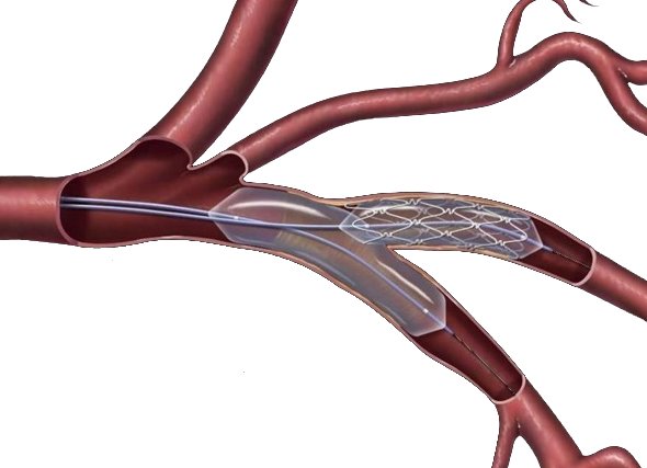 Стент в подвздошной артерии - операция