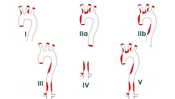 Классификации неспецифического аортоартериита Классификации неспецифического аортоартериита