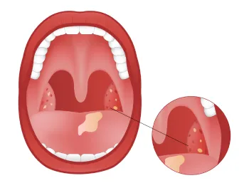 Тонзиллит - определение болезни