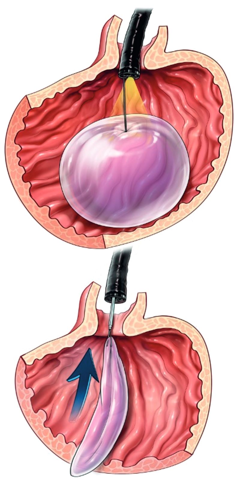удаление внутрижелудочного баллона