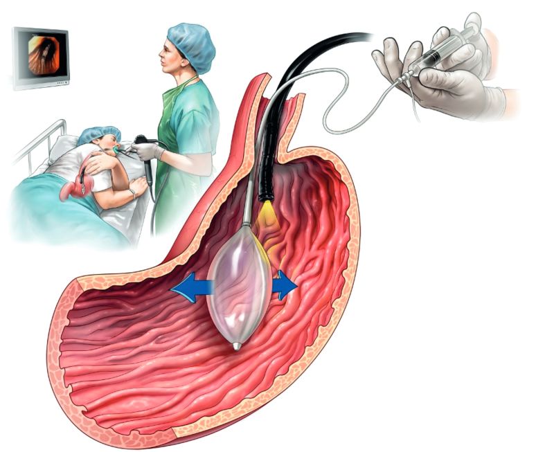 установка внутрижелудочного баллона установка внутрижелудочного баллона