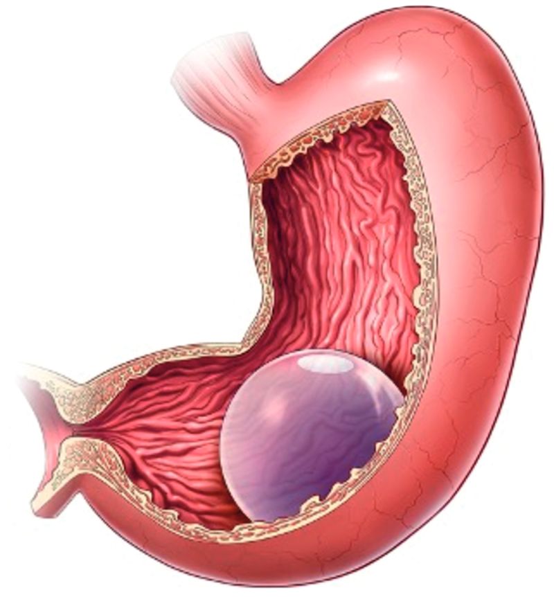 Установленный баллон в желудке Установленный баллон в желудке
