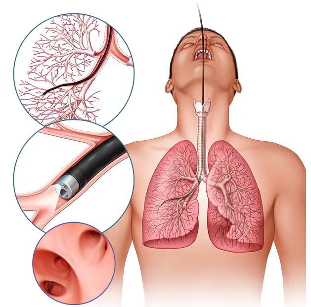 Бронхоскопия легких