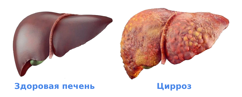 Цирроз печени симптомы