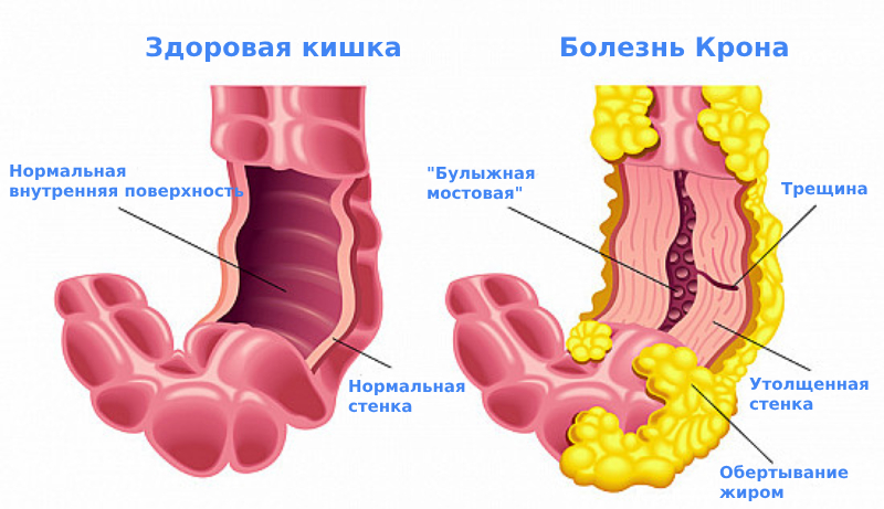 Язвенная болезнь Крона