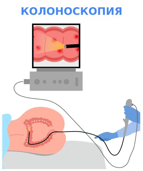 Диагностика рака прямой кишки