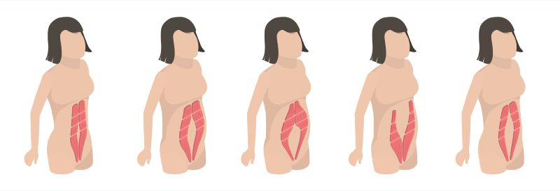 Диастаз прямых мышц живота