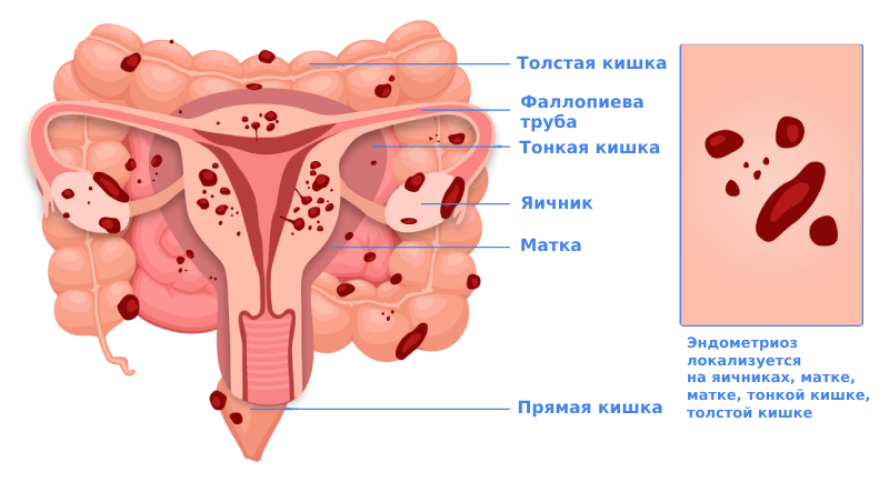 Эндометриоз кишечника симптомы