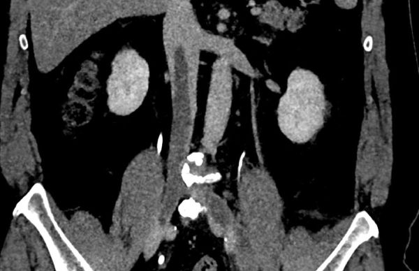 Флотирующий тромбоз вен Флотирующий тромбоз вен