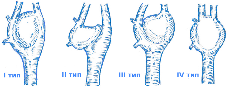 Параганглиома