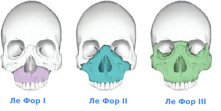 Перелом костей лицевого скелета
