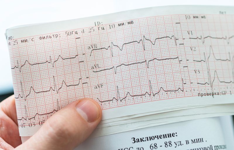 Мерцательная аритмия симптомы