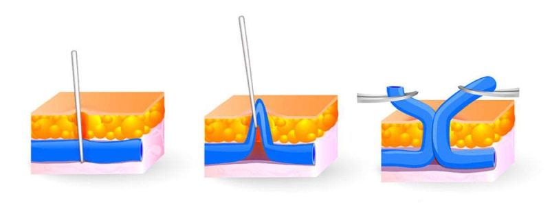 Минифлебэктомия нижних конечностей