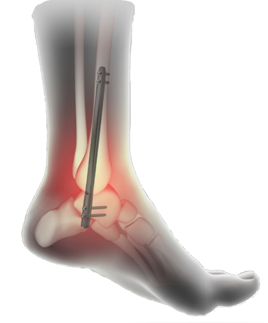 Операция артродез