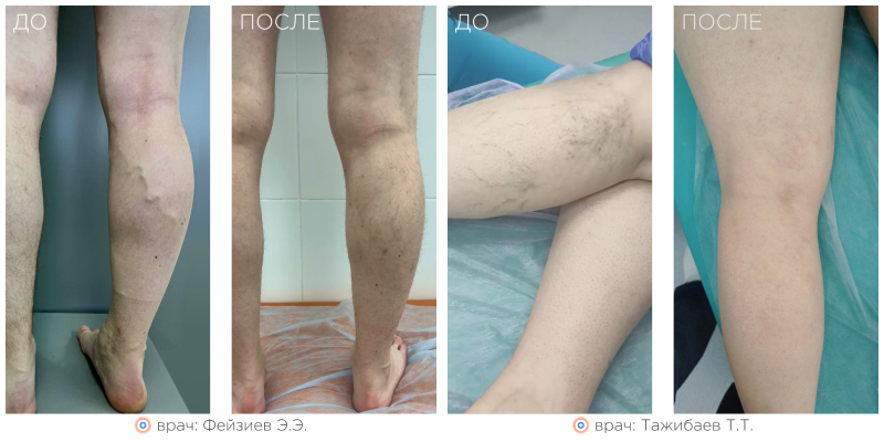 Флебэктомия вен нижних конечностей - результаты работ