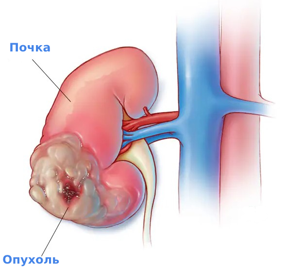 Признаки рака почек Признаки рака почек