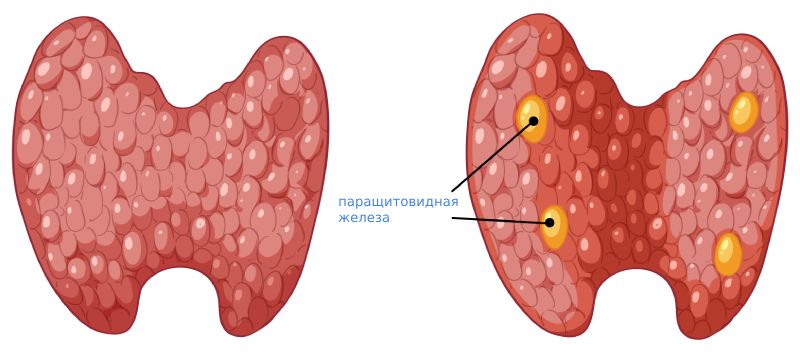 Аденома околощитовидной железы Аденома околощитовидной железы