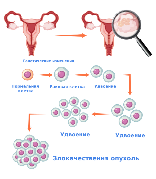 Стадии развития рака яичников