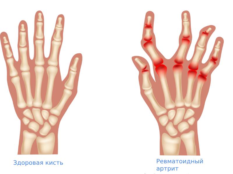 Ревматоидный артрит симптомы
