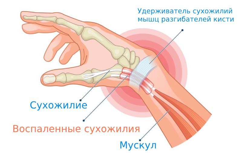 Синдром де Кервена Синдром де Кервена