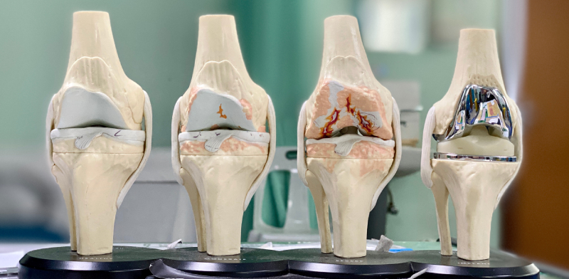 Степени деформирующего артроза коленного сустава Степени деформирующего артроза коленного сустава