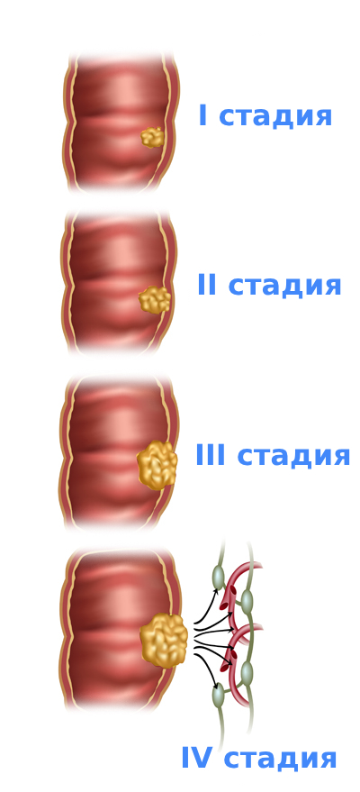 Стадии рака прямой кишки