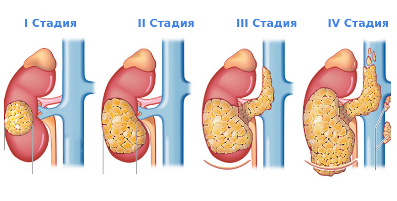 Стадии рака почки Стадии рака почки