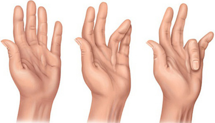 Cтенозирующий лигаментит