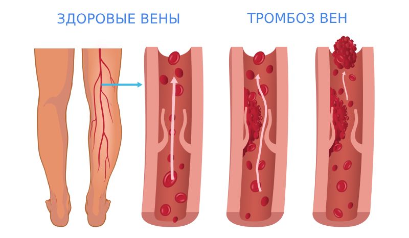 Тромбоз глубоких вен