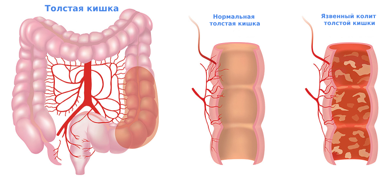 Язвенный колит симптомы