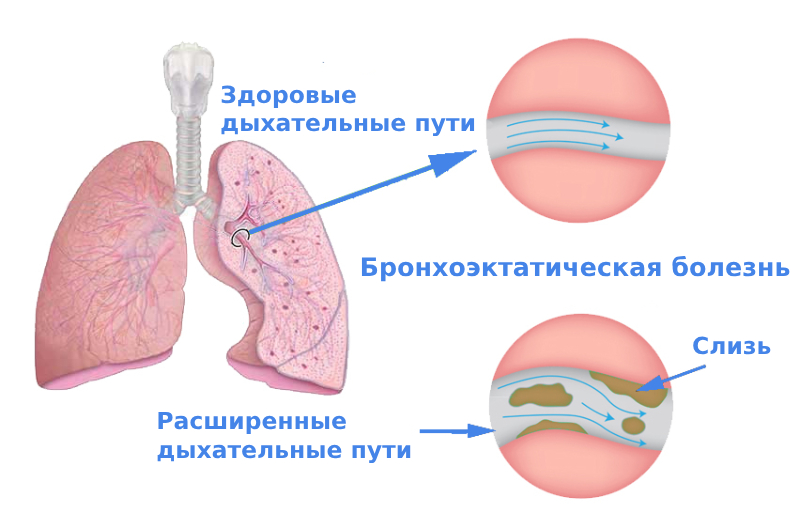 Бронхоэктатическая болезнь легких причины и лечение