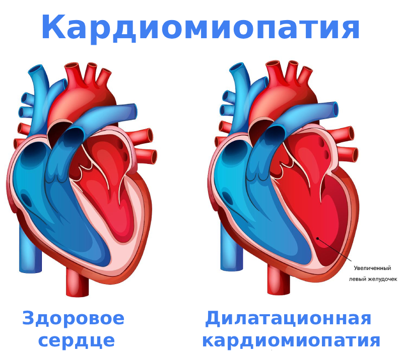 Дилатационная кардиомиопатия сердца