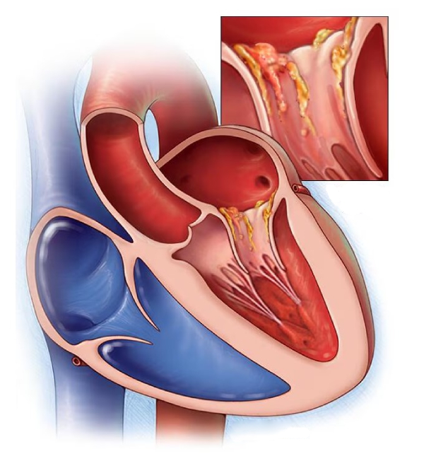 Эндокардит клапана