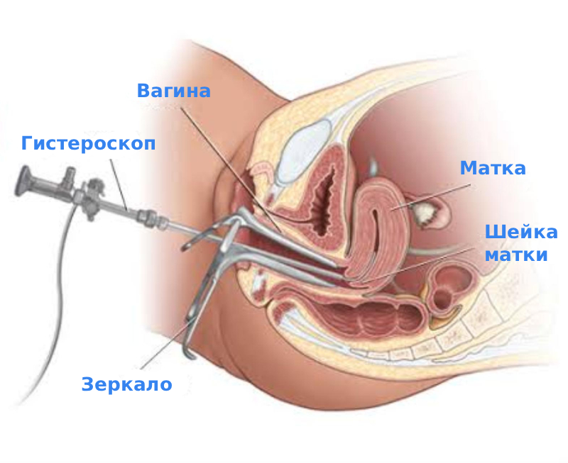 Гистероскопия матки
