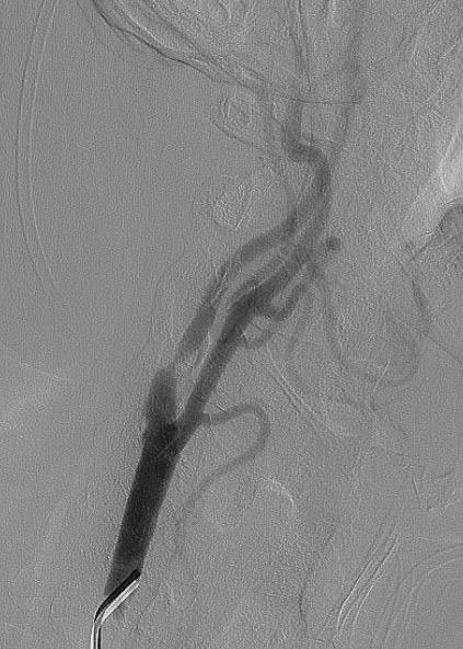 Стентирование - операция -3