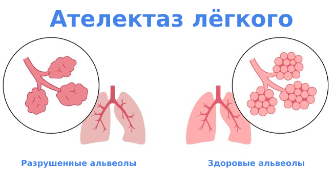 Ателектаз легких причины и лечение